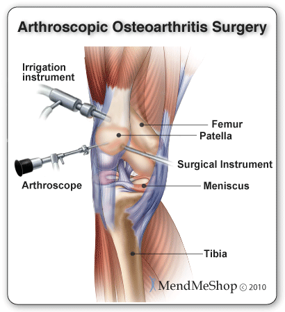 How is arthroscopic knee surgery performed?
